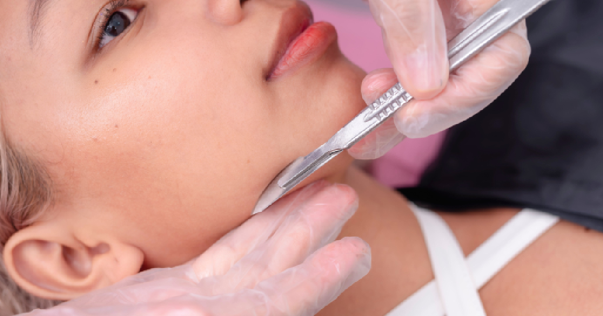 Close-up of a woman receiving a dermaplaning treatment, with a professional using a scalpel to gently remove fine facial hair and dead skin, wearing gloves in Allen, TX